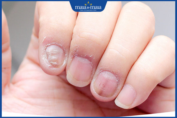 Nấm móng tay có lây không? Cách phòng ngừa hiệu quả 2 bị nấm móng tay