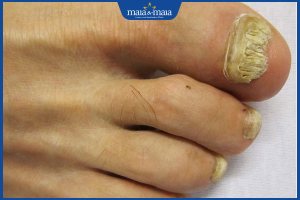 Nấm da không ngứa là bệnh gì? Nên làm gì để phòng ngừa? 3 bị nấm móng