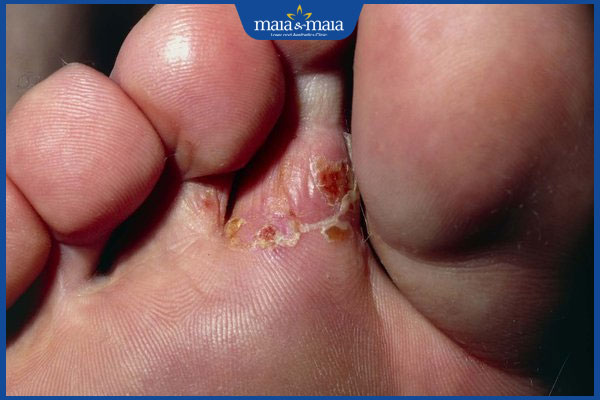 bị nấm ở chân