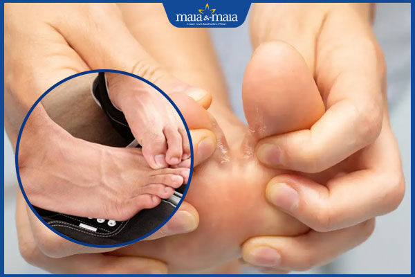 Triệu chứng nấm kẽ chân và các biện pháp điều trị hiệu quả 2 bị nấm ở kẽ chân