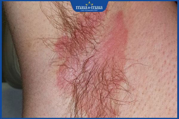 bị nấm ở nách