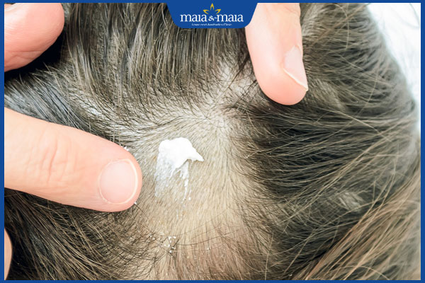 bị rụng tóc do nấm da đầu