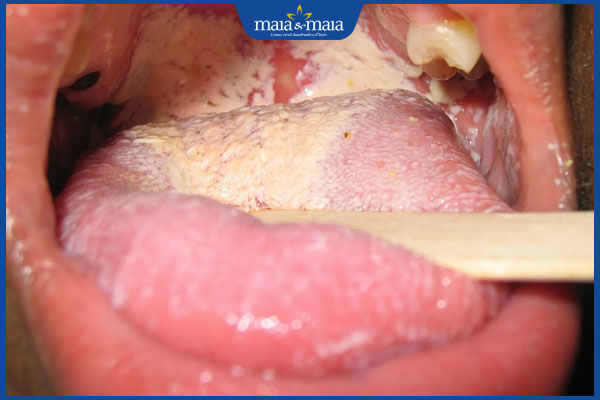 biến chứng nấm lưỡi