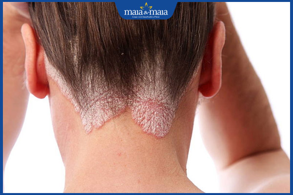 biểu hiện nấm da đầu