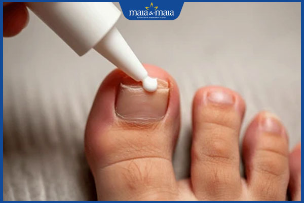 bôi nấm móng chân