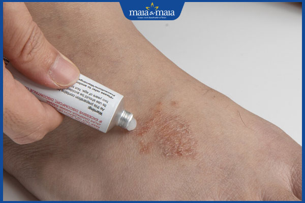 bôi thuốc kháng nấm