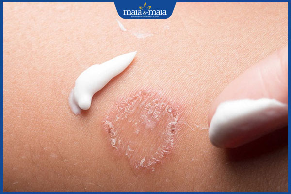 bôi thuốc trị nấm bẹn