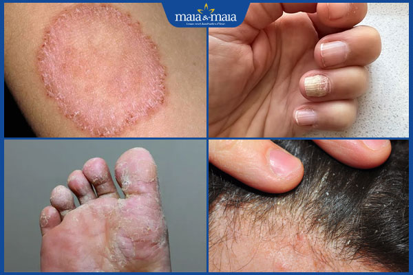 Bệnh nấm da: Nguyên nhân, cách điều trị và phòng tránh 2 các loại nấm da