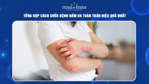 cách chữa bệnh nấm da toàn thân