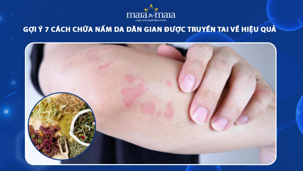 Gợi ý 7 cách chữa nấm da dân gian được lưu truyền hiện nay 1 cách chữa nấm da dân gian