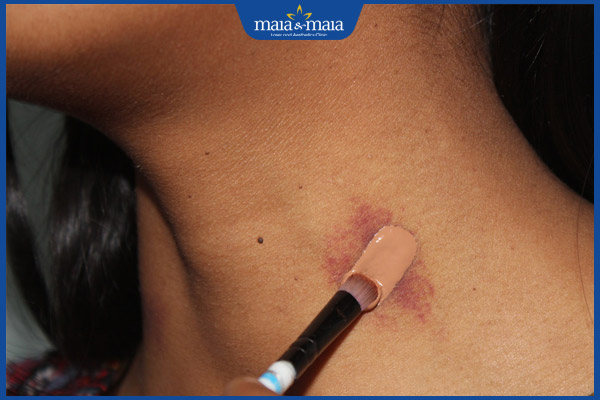 Hickey là gì? Bao lâu thì hết? Mẹo xóa dấu hôn nhanh nhất 3 che dấu hôn