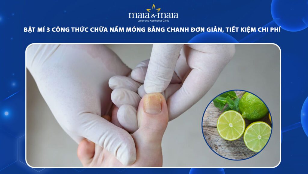 3 cách chữa nấm móng tay bằng chanh và hiệu quả thực tế 1 chữa nấm móng tay bằng chanh