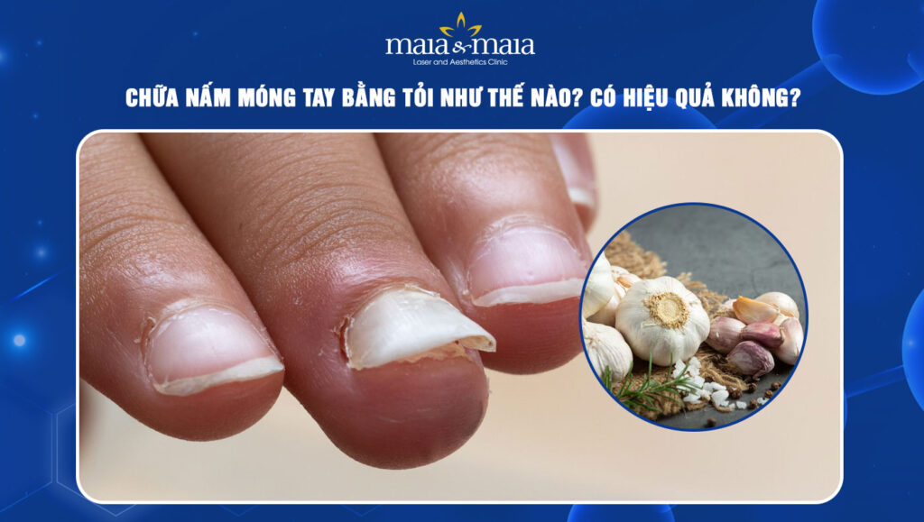 Chữa nấm móng tay bằng tỏi như thế nào? Có hiệu quả không? 1 Chữa nấm móng tay bằng tỏi