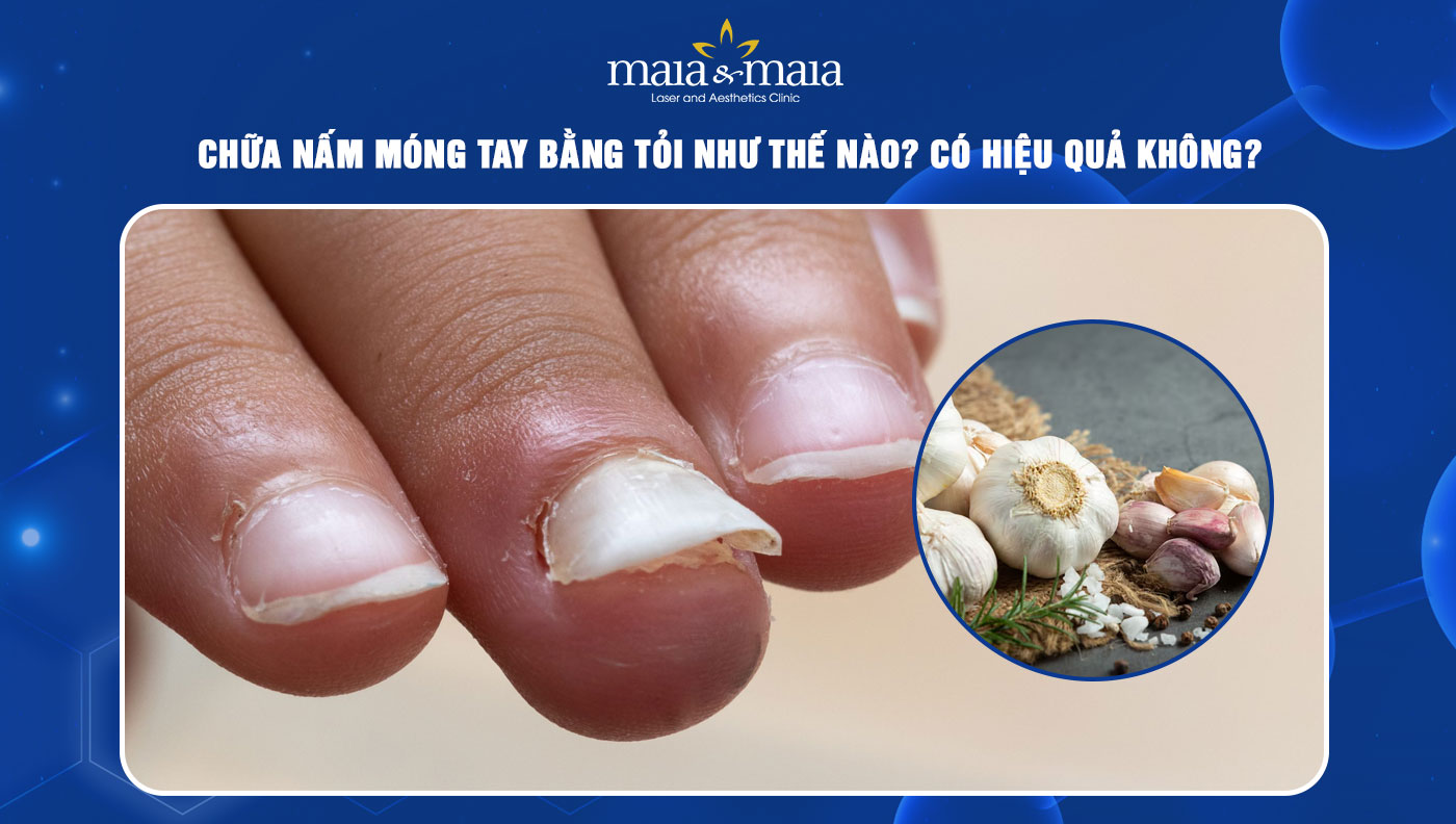 Chữa nấm móng tay bằng tỏi