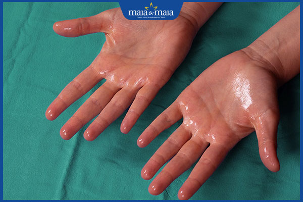 Nấm móng tay có lây không? Cách phòng ngừa hiệu quả 3 cơ địa nhiều mồ hôi