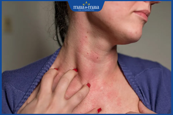 Nấm da cổ: Dấu hiệu nhận biết và phương pháp điều trị 3 cổ ngứa ngáy