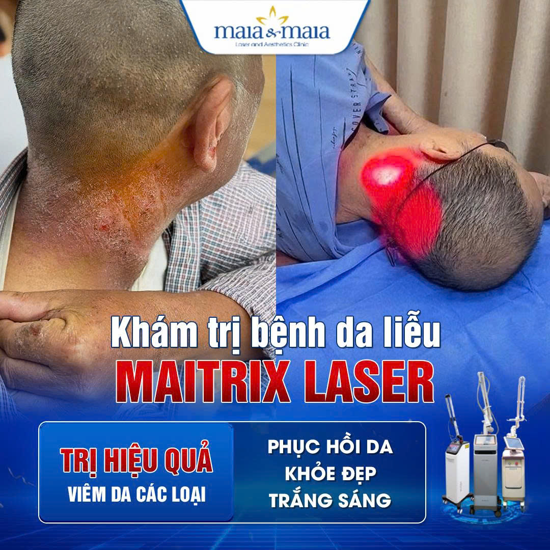 cong nghe tri benh da lieu