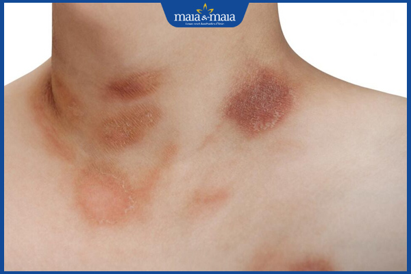 Nấm da cổ: Dấu hiệu nhận biết và phương pháp điều trị 2 da cổ nhiễm nấm