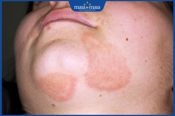 Nấm da mặt do đâu? Cách xử lý và phòng ngừa tái phát 2 dấu hiệu nấm da mặt