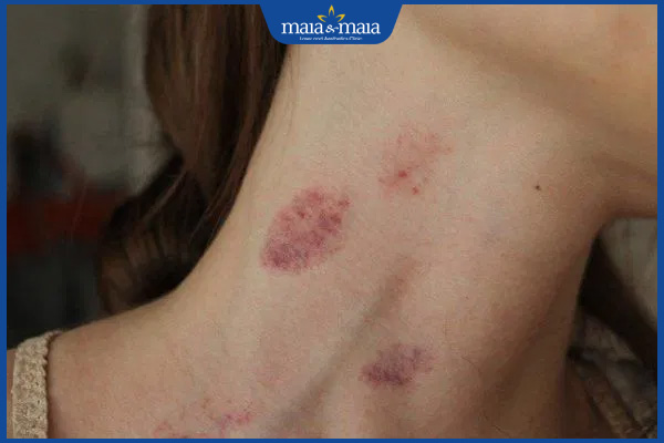 Hickey là gì? Bao lâu thì hết? Mẹo xóa dấu hôn nhanh nhất 2 dấu hôn ở cổ