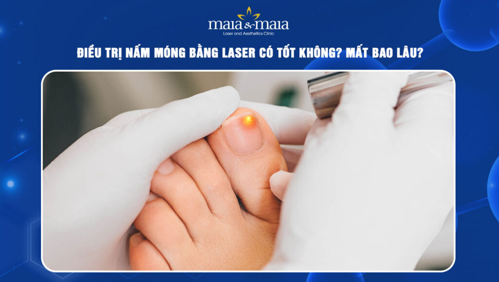 điều trị nấm móng bằng laser