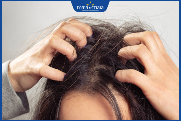 gãi đầu dữ dội