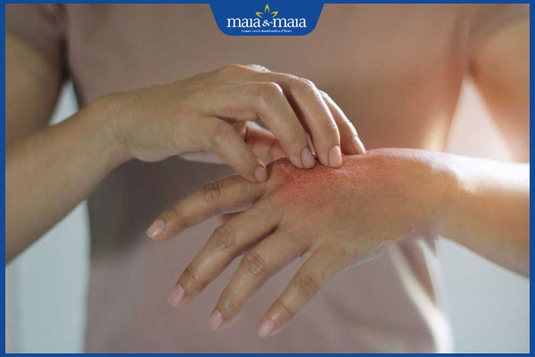 Bệnh nấm da tay: Nhận biết, nguyên nhân và cách điều trị 5 gãi ngứa do nấm