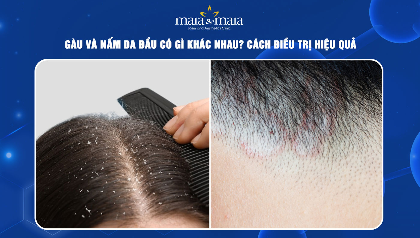 Gàu và nấm da đầu