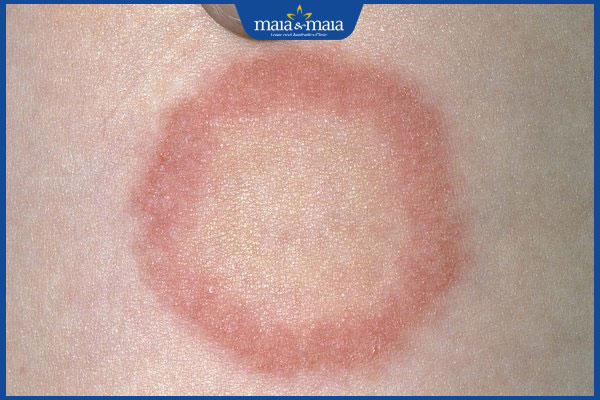 Hình ảnh bệnh nấm da mặt từng giai đoạn và cách nhận biết 5 hắc lào trên mặt