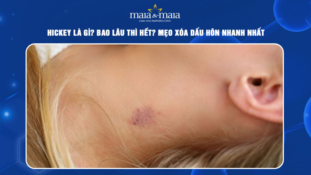 Hickey là gì? Bao lâu thì hết? Mẹo xóa dấu hôn nhanh nhất 1 hickey