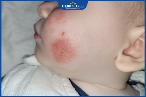 hình ảnh nấm da ở trẻ