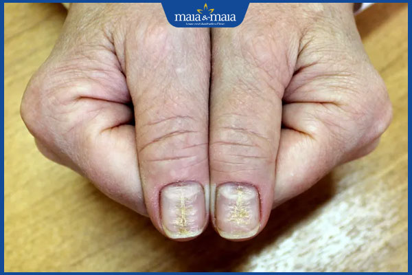 hình ảnh nấm móng tay