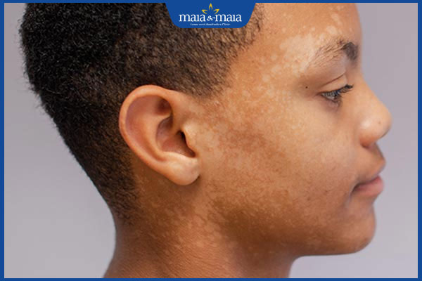 Hình ảnh bệnh nấm da mặt từng giai đoạn và cách nhận biết 6 lang ben ở mặt