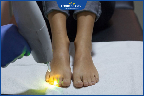 laser chữa nấm chân
