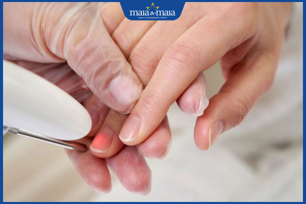 laser trị nấm móng