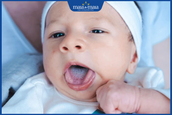 mảng bám ở lưỡi