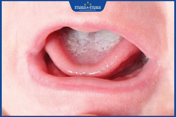 mảng nấm lưỡi trắng