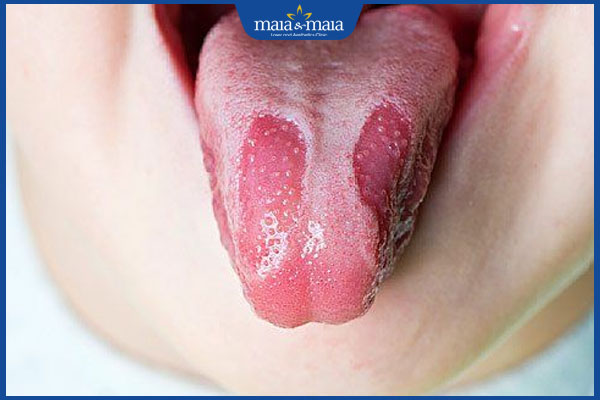 mảng trắng ở lưỡi