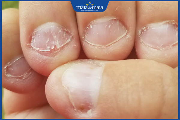 móng khó hồi phục