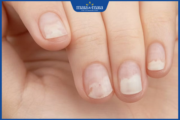 móng tay bị nấm