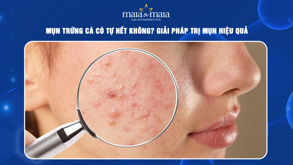Mụn trứng cá có tự hết không? Giải pháp trị mụn hiệu quả 1 mụn trứng cá có tự hết không