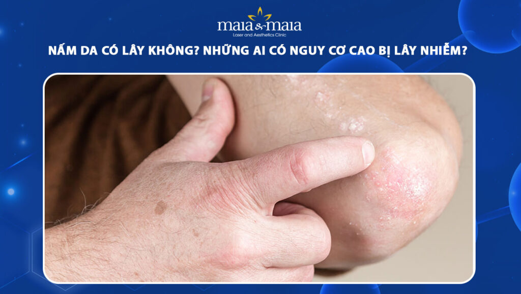 Nấm da có lây không? Đối tượng có nguy cơ cao bị lây nhiễm? 1 nấm da có lây không