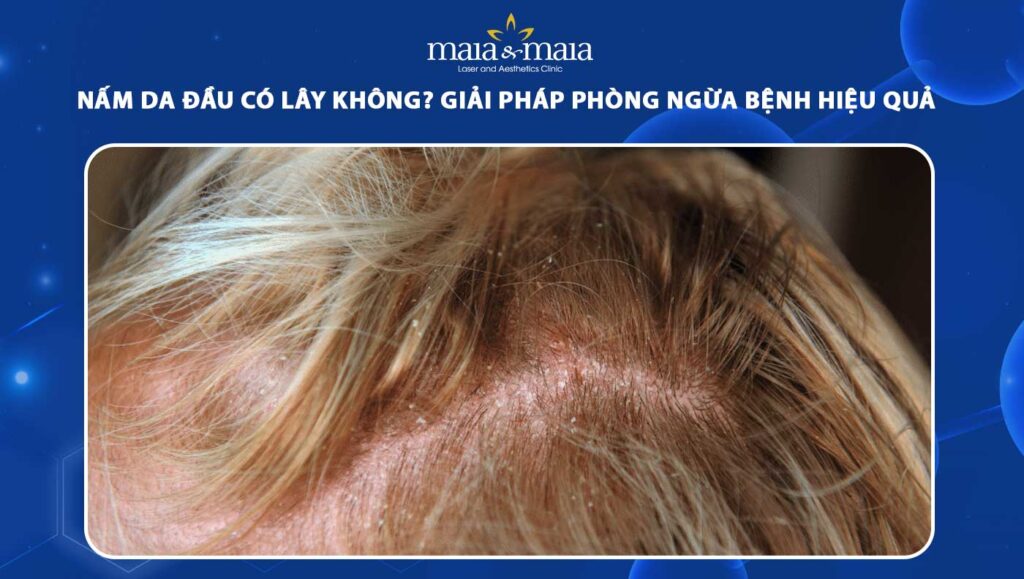 nấm da đầu có lây không