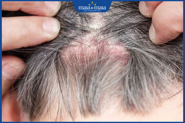 nấm da đầu gây đỏ