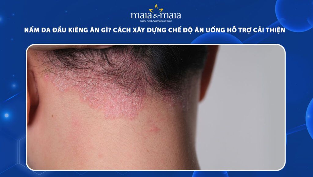 Nấm da đầu kiêng ăn gì? Chế độ ăn giúp cải thiện hiệu quả 1 nấm da đầu kiêng ăn gì