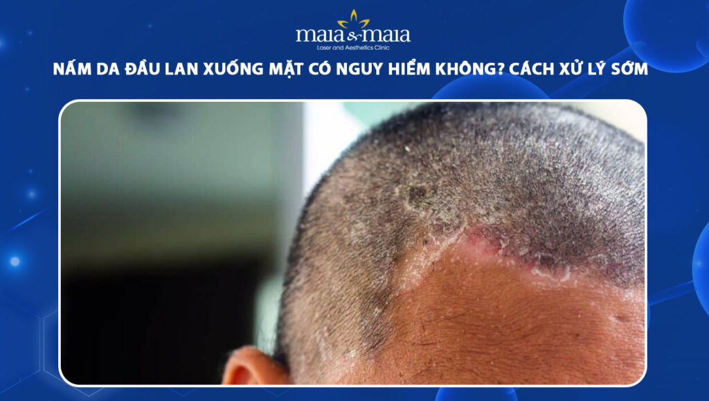 nấm da đầu lan xuống mặt