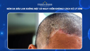 nấm da đầu lan xuống mặt