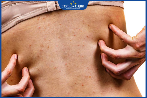 nấm da gây ngứa ngáy