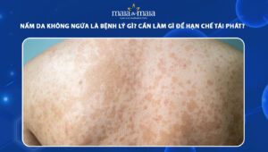 nấm da không ngứa