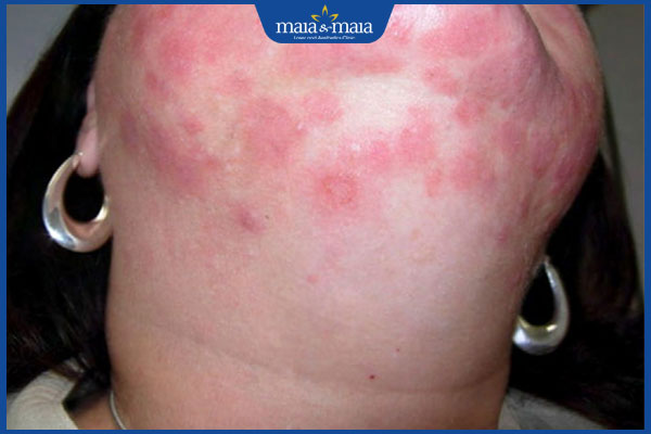 Hình ảnh bệnh nấm da mặt từng giai đoạn và cách nhận biết 4 nấm da lan rộng